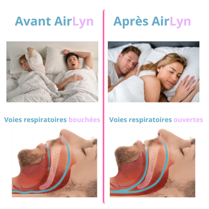 AirLyn™ - Orthèse anti-ronflement et apnée du sommeil.